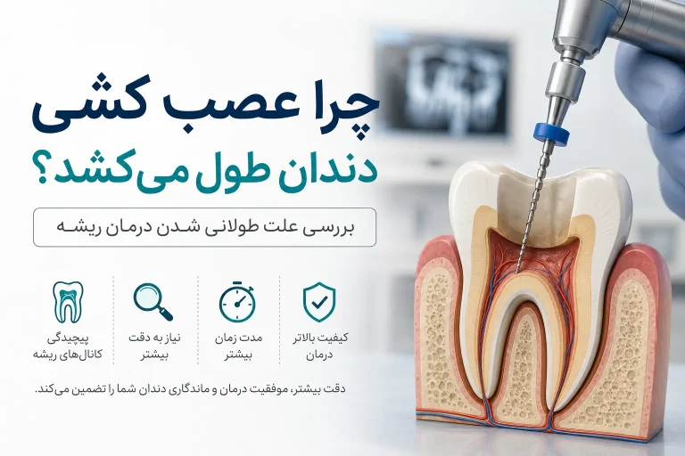چرا عصب کشی دندان طول می‌کشد؟ علت طولانی شدن درمان ریشه