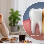 آیا ریزه خواری باعث پوسیدگی دندان میشود